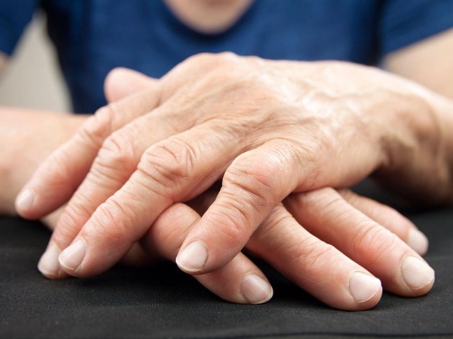 Artritis reumatoide debe atenderse para evitar daño extremo