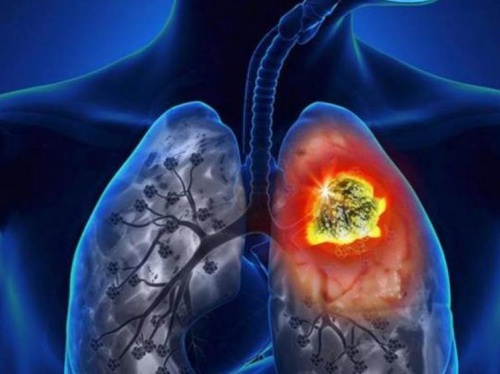 Cáncer de pulmón: primera causa de muerte por tumores
